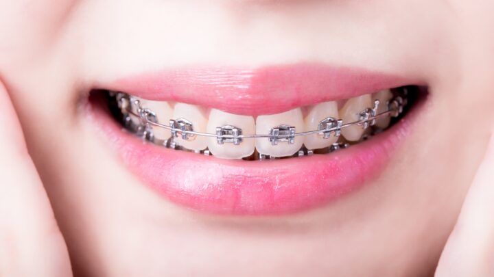 Co warto wiedzieć przed założeniem aparatu stałego ortodontycznego?